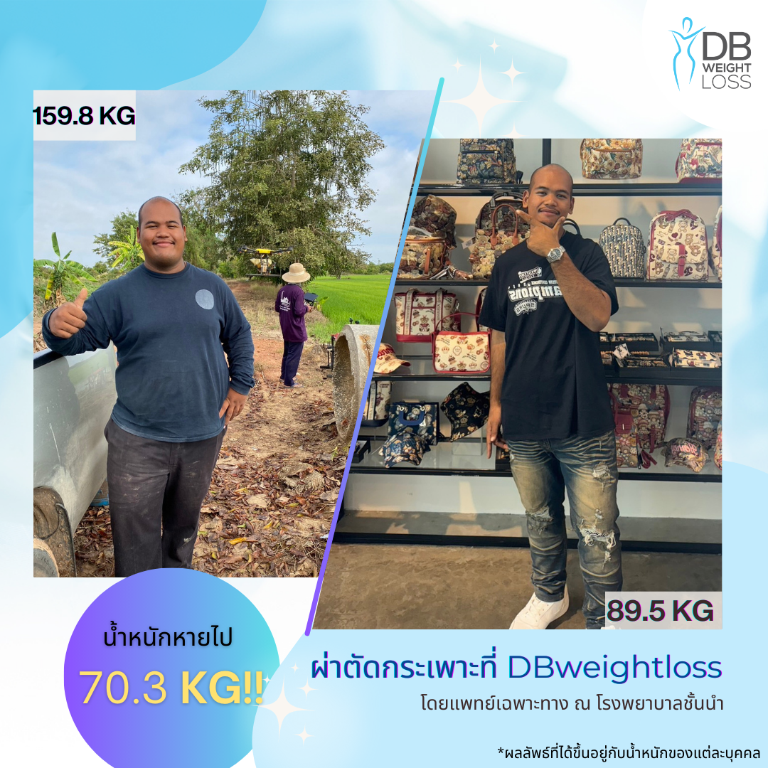 คุณศุภณัฐน้ำหนักลดลง 70 กิโลหลังผ่าตัดกระเพาะ